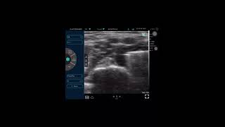 supraclavicular brachial plexus block by easy way [upl. by Dierdre]