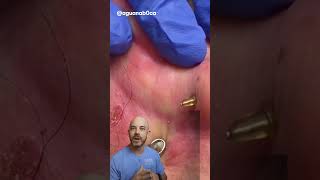 This is an iconic ear cyst extraction 👂credit aguanab0ca on TT doctor satisfying viral [upl. by Maccarthy45]