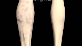 Deep Venous Thrombosis DVT Signs and Symptoms Animation by Cal Shipley MD [upl. by Nevah]