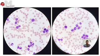 LEUCEMIA MIELOIDE CRÓNICA REPASANDO EL HEMOGRAMA Y FROTIS DE SANGRE PERIFÉRICA [upl. by Neitsirk]