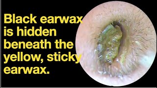 Black earwax is hidden beneath the yellow sticky earwaxear wax removal  ear cleaning  ASMR [upl. by Tsiuqram]