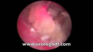 Ureterolitotripsia Dr Urólogo Víctor Severo H [upl. by Akiram383]