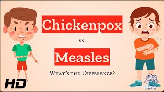 Chickenpox vs Measles Which is Which [upl. by Ydualc]