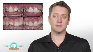 Video Buyers Guide Dental Composites [upl. by Glen]