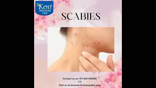 scabies Best homeopathy treatment Drkukreja kalani online consult 8291492566 [upl. by Nnaihs136]