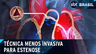 SUS oferece técnica menos invasiva para o tratamento de estenose aórtica  SBT Brasil 170424 [upl. by Snell]