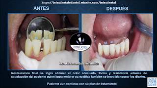 cierre de diastema en dientes inferiores [upl. by Irdua]