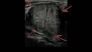 AN INTERESTING CASE OF SUPRACLAVICULAR LYMPHADENOPATHY  FIND THE CAUSE [upl. by Janenna663]