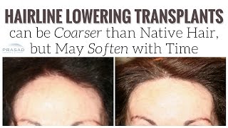 Why Transplanted Hair at the Hairline May Grow Thicker than Native Scalp Hair but Soften with Time [upl. by Aldwin904]