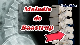 Maladie de Baastrup Arthrose interepineuses vertébrale arthropathie interépineuse de contact [upl. by Horacio]