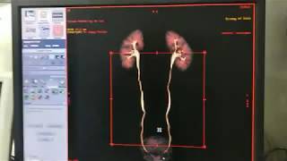 Full Work Of CT Urography Urogram with 3D On GE 16 Slice Scanner [upl. by Giffie]