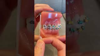 How to Use OrthoDots if Ortho Wax keeps falling off  Dr Bar The Braces Doc [upl. by Gwen846]