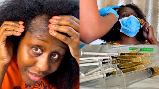 PRP Treatment For Hair Loss  Platelet Rich Plasma For Hair Loss  Postpartum Alopecia  Vlog [upl. by Airret]