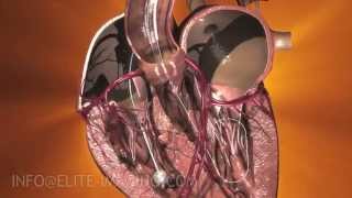 Heart Valve Implantation Full Procedure  Medical amp Scientific Video Production [upl. by Edmondo]