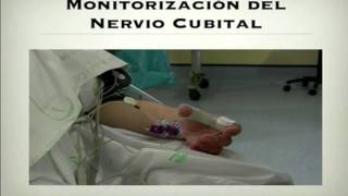 Podcast 4 Curso de Monitorización Neuromuscular Parte 2 [upl. by Hippel]