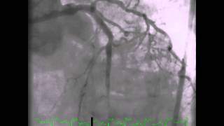 Angiogram Left Coronary Artery With Proximal Occlusion LAD [upl. by Balcer]