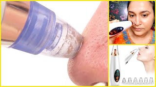 1 min blackheads amp whiteheads remove method OMG IT WORKED suction blackhead remover Review amp Demo [upl. by Atikat]