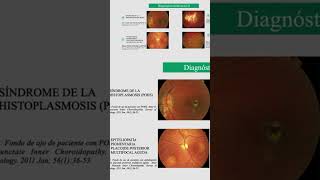 Síndrome de la Histoplasmosis Ocular [upl. by Htehpaj]