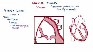 Cardiac tumors Myxoma Rhabdomyoma causes symptoms amp pathology [upl. by Wawro424]