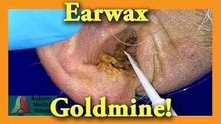 Earwax GOLDMINE  Auburn Medical Group [upl. by Gabbi816]