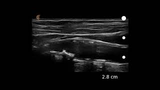 Image Interpretation Carotid Atherosclerosis [upl. by Castara]