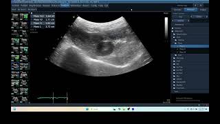 IQ 280 LIVER HEPATOMA ULTRASOUND ECHOPAC ANALYSIS C15RS probe [upl. by Rainer868]