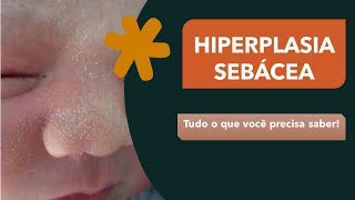 HIPERPLASIA SEBÁCEA  O que você precisa saber  Erupção Transitória do RecémNascido  quotbebêquot [upl. by Ugo]