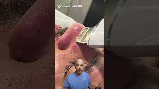 Watch this pore spatula in action 🍴credit basemkhaled123 on TT doctor satisfying viral [upl. by Isabel55]