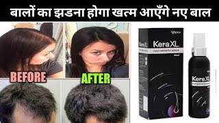 Kera XL New hair growth serum review बालों को झड़ने से रोक कर नए बाल उगाने वाला serum [upl. by Thevenot]