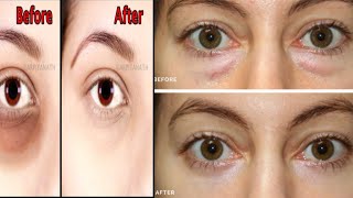 Miracle undereye treatment puffy eyes swollen eyes permanentlyyet bright eyes amp beautiful eyes [upl. by Gonta]