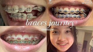 Braces Overbite Time lapse with extractions [upl. by Hultin]