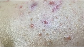 How to Get Rid of Teenage Acne HoangMySpa128 [upl. by Carmella]