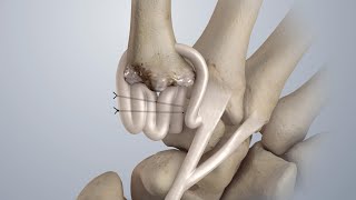 Osteoarthritis of the Thumb Surgical Treatment LRTI [upl. by Lorolla884]