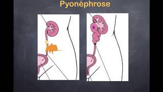 Infections urinaires  4 Pyélonéphrite aiguë  Complications [upl. by Primalia]