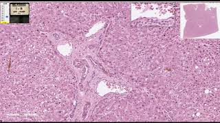 Os 15 SINAIS de GORDURA NO FÍGADO esteatose hepática como ELIMINAR EXAMES e o que PIORA 🤢 [upl. by Sylera78]