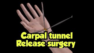 How carpal tunnel is released by open surgery to treat Carpal Tunnel Syndrome CTS [upl. by Trixie]