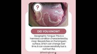 Geographic tongue Did you know Feedingbrain geographictongue tonguedisease [upl. by Eam85]