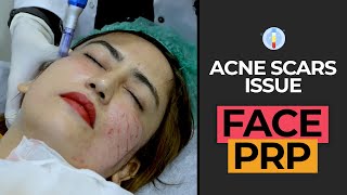 FACE PRP FOR ACNE SCARS  HASH CLINICS [upl. by Elisha]