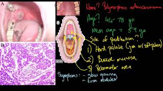 polymorphous adenocarcinoma [upl. by Sokin]