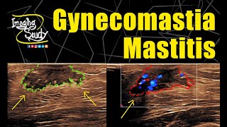 Gynecomastia with Mastitis  Ultrasound  Doppler  Case 279 [upl. by Vivica]