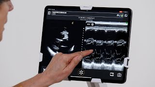 Ejection Fraction with EPSS [upl. by Analart899]