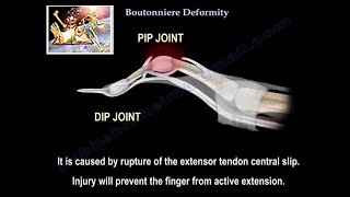 Boutonniere Deformity  Everything You Need To Know  Dr Nabil Ebraheim [upl. by Eislel]