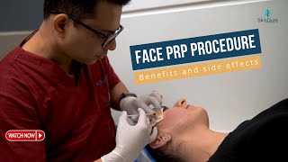 Face PRP Procedure  Benefits and side effects  SkinQure [upl. by Alel]