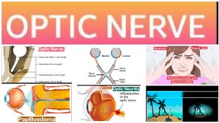 Optic Nerve 2Major Papilloedema 1 [upl. by Nasah]