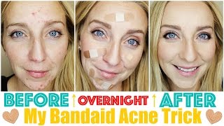 How to Get Rid of Acne Fast amp OVERNIGHT with My Bandaid Trick [upl. by Kcarb]