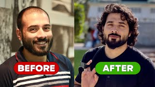 My Remarkable Hair Transplant Journey  From Baldness to Boldness [upl. by Chon]