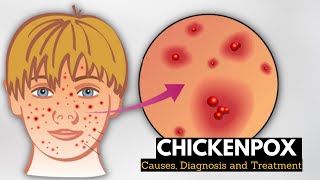 Chickenpox Causes Signs and Symptoms Diagnosis and Treatment [upl. by Mathilda]