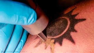 How Laser Tattoo Removal Works  Smarter Every Day 123 [upl. by Erdnad684]