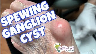 Spewing Ganglion Cyst [upl. by Bullen]