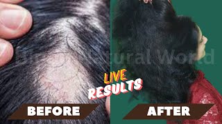 Receding Hairline Regrowth  Hair Regrowth at 40  Regrow Hair After 40 Going Natural from Chemical [upl. by Anoid]